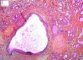 Cervical branchial cyst