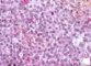 Ewing sarcoma
