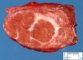 Focal nodular hyperplasia