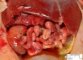 Duodenal dilatation by duodenal atresia in multiple intestinal atresia (...)