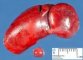 Bilobated spleen with accessory spleen
