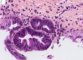 Biliary epithelial dysplasia in choledochal cyst
