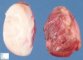 Extra-abdominal desmoid tumor