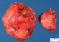 Intermixed ganglioneuroblastoma