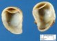 Intestinal duplication cyst