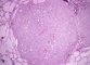 Microscopic medullary thyroid carcinoma with follicular pattern (...)