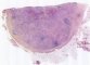 Nodal cryptococcosis (Cryptococcus neoformans)