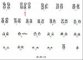 Tumoral trisomy 2 in hepatoblastoma