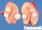 Uterine leiomyomas.