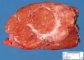 Focal nodular hyperplasia