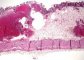 Colonic pneumatosis in cystic fibrosis
