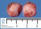 Intestinal myoepithelial hamartoma