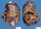 Intrapulmonary bronchogenic cyst