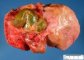 Kasai procedure in extra-hepatic biliary tract atresia