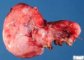 Ovarian corpus luteum (Ovarian luteal cyst)