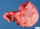 Ovarian luteal cyst