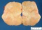Ovarian fibrothecoma