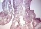 pleuropulmonary blastoma type 1