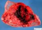 A frequent cause of fetal death: retroplacental hematoma