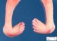 Club feet in a spina bifida with myelomeningocele (neonate)