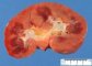 renal Wegener granulomatosis