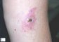 Cutaneous leishmaniasis