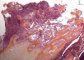 Precursor B lymphoblastic lymphoma (osseous localization)