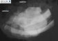 Ewing sarcoma of the rib - radiology of the specimen