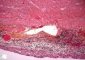 Local peritonitis in acute appendicitis