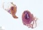 Branchial cyst