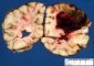 Cerebral vascular malformation with cerebral hemorrhages