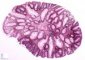 Colonic tubulous adenoma