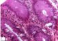 Colonic GVHD