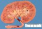 Multiple fungal abcesses in the renal parenchyma