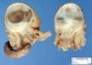 Ileocaecal digestive duplication cyst