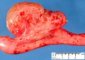 Intestinal lymphangioma