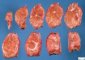 Focal nodular hyperplasia