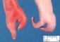 Ectrodactyly with cardiac malformation (case 12772)