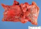 Crohn ileitis