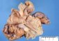 Crohn ileitis with parietal lipomatosis