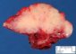 Cervical desmoid fibromatosis