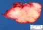 Cervical desmoid fibromatosis