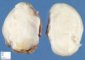 Extra-abdominal desmoid tumor