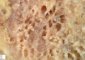 Pulmonary giant cystic chondroid hamartoma