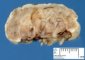 Infantile hemangioma