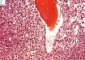 Bone marrow infiltration by large myeloid cells in Kostmann (...)
