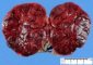 Necrosis of a lipoma after mechanical torsion