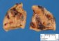 Parathyroid adenoma