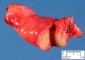 Pulmonary myofibroblastic inflammatory tumor
