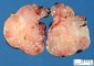 salivary gland anlage tumor
